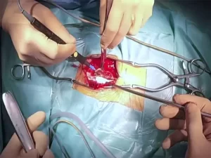 جراحی-آندوسکوپی-دیسک